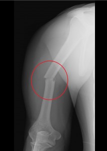 How long does it take to recover from a humerus bone fracture?